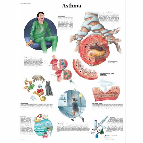 Asthma Chart - 3B