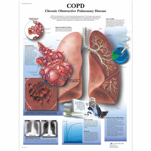 COPD Chart - Chronic Obstructive Pulmonary Disease - 3B