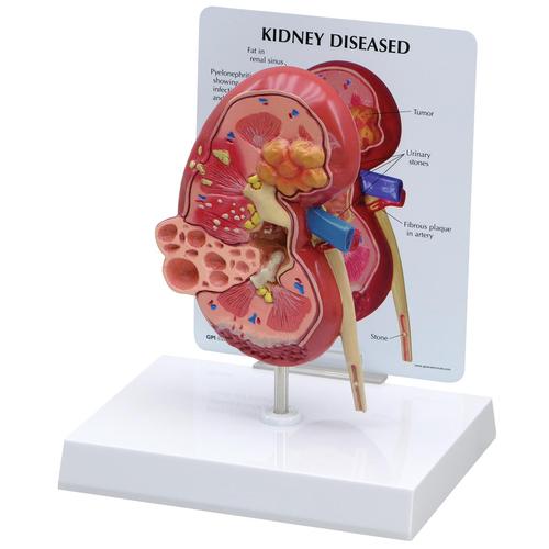 Diseased Kidney Model - 3B