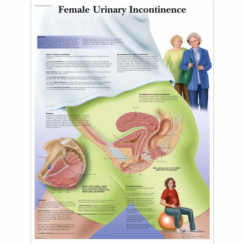 Female Urinary Incontinence Chart - 3B
