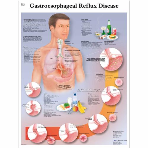 Gastroesophageal Reflux Disease Chart (GERD) - 3B