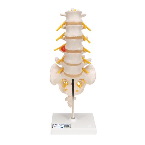 Human Lumbar Spinal Column Model with Dorso-Lateral Prolapsed Intervertebral Disc - 3B