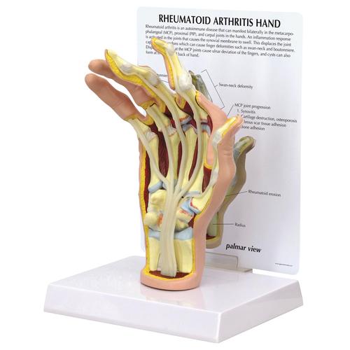 Rheumatoid Arthritis Hand Model - 3B