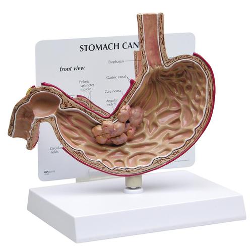Stomach Cancer Model - 3B