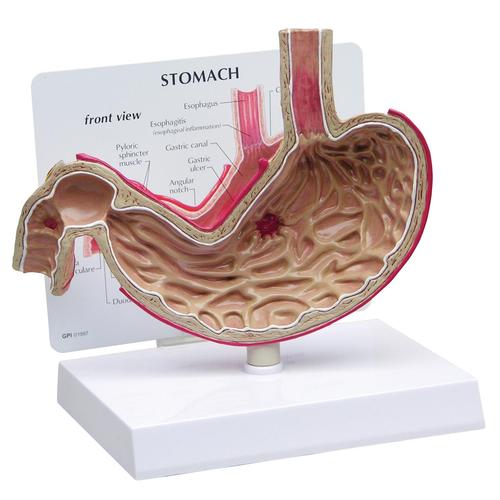 Stomach Model with Ulcers - 3B
