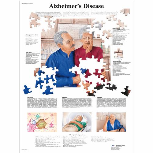 Alzheimer's Disease Chart - 3B