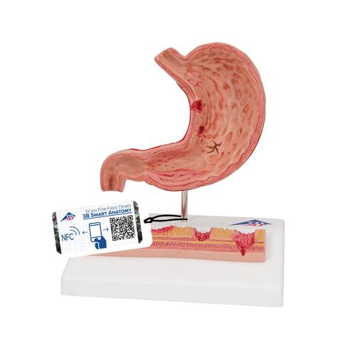 Human Stomach Section Model with Ulcers - 3B