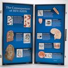 The Consequences of HIV/AIDS - 3D Display