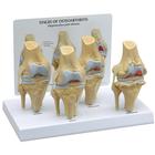 Osteo Knee Model Set - 4 Stage