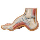 Hollow Foot (Pes Cavus)