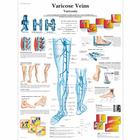 Varicose Veins Chart