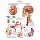 Stroke Chart