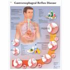 Gastroesophageal Reflux Disease Chart (GERD)
