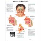 Rhinitis and Sinusitis Chart