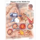 Diseases of the Middle Ear Chart