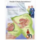 Female Urinary Incontinence Chart