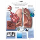 COPD Chart - Chronic Obstructive Pulmonary Disease