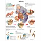 Arthritis Chart