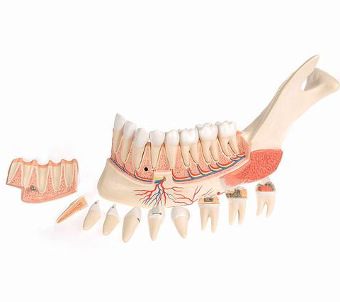 Comprehensive Lower Jaw Model (Left Half) with Diseased Teeth, Nerves, Vessels & Glands, 19 part