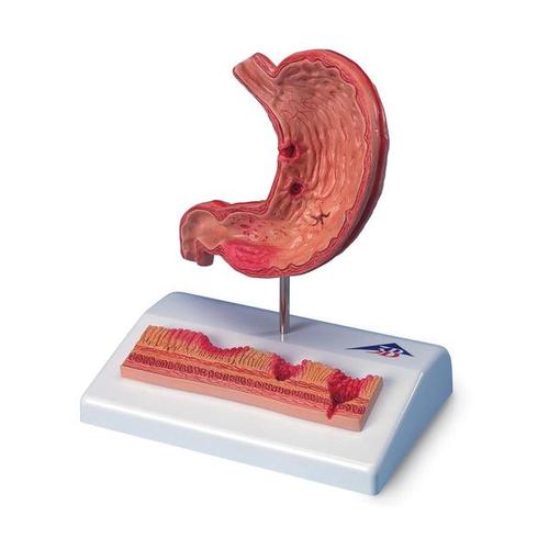 Human Stomach Section Model with Ulcers