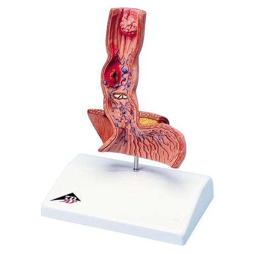 Life-Size Human Esophagus Diseases Model - 3B