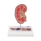 Kidney Stone Model