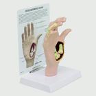 Hand Model - Osteoarthritis
