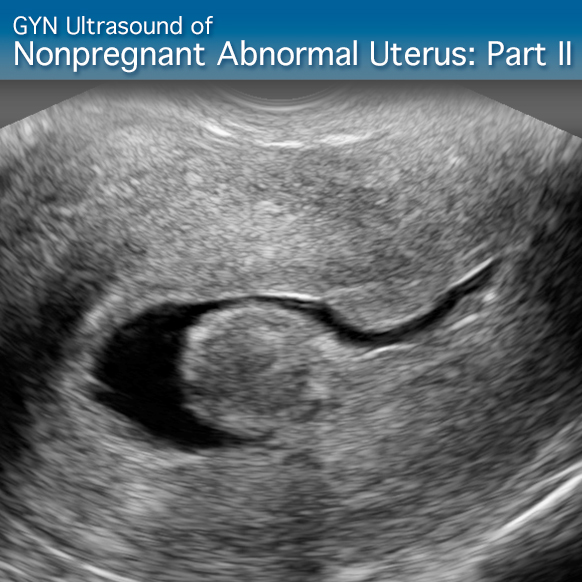 Advanced Clinical Module: GYN Ultrasound of Nonpregnant Abnormal Uterus  Part II