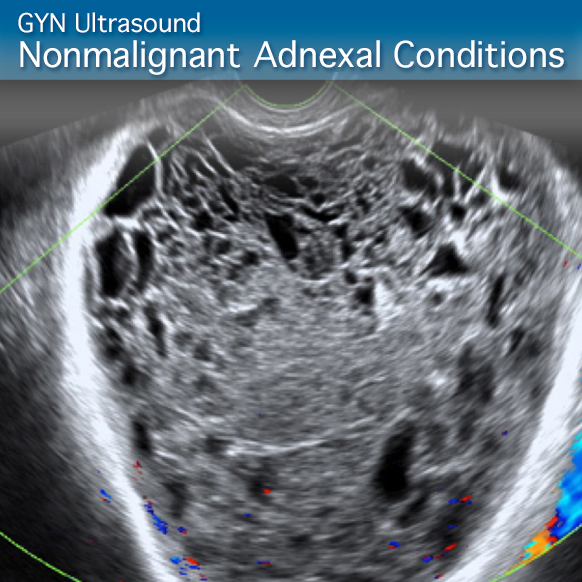 Advanced Clinical Module: GYN Ultrasound Nonmalignant Adnexal Conditions