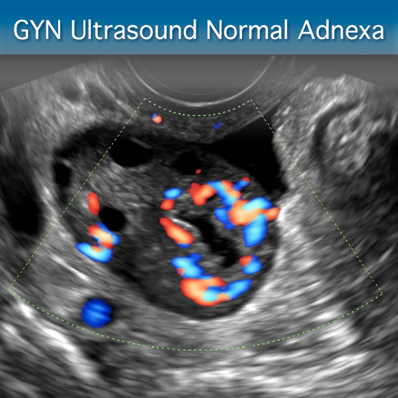 Advanced Clinical Module: GYN Ultrasound Normal Adnexa