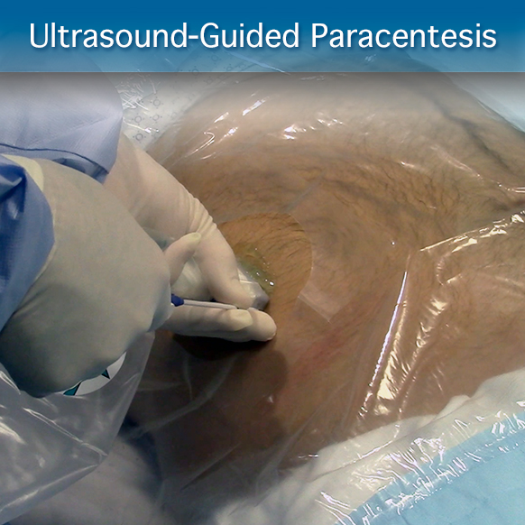 Procedure Module: Ultrasound-Guided Paracentesis