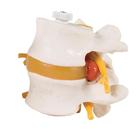 2 Lumbar Vertebrae with prolapsed disc, flexibly mounted