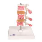 Osteoporosis Model - Deluxe - (3 Vertebrae)
