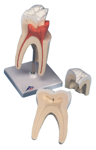 Upper Triple-Root Molar, Cavities In Molars. Upper Triple-Root Molar,