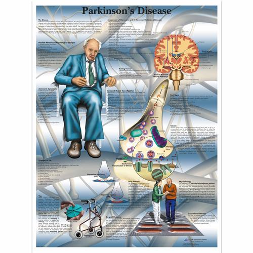 2 Parkinsons-Disease-Chart