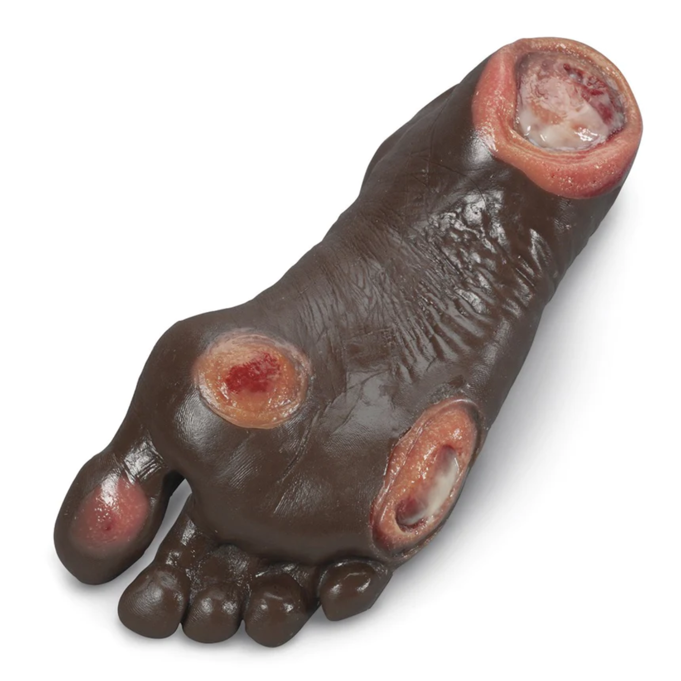 Elderly Pressure Ulcer Foot - Dark
