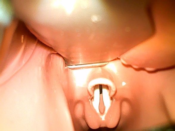 airwaychild vocal cords