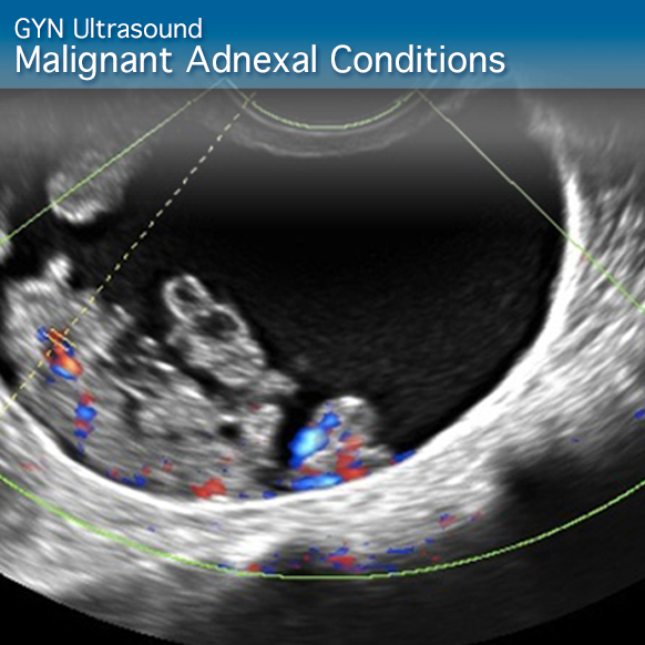 Advanced Clinical Module: GYN Ultrasound Malignant Adnexal Conditions.