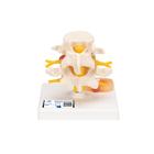 Human Lumbar Spinal Column with Prolapsed Intervertebral Disc