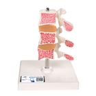 Deluxe Human Osteoporosis Model (3 Vertebrae with Discs ), Removable on Stand