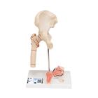 Human Femoral Fracture & Hip Osteoarthritis Model