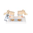 Osteoporosis Didactic Model