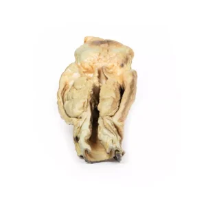 Carcinoma of Larynx