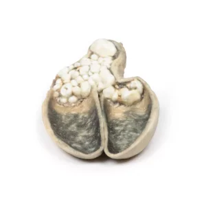 Cholecystitis and Cholelithiasis