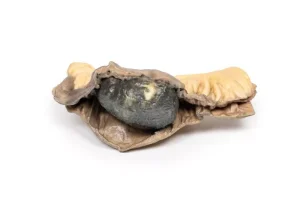 Gall Stone Ileus
