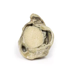 Hydrocoele