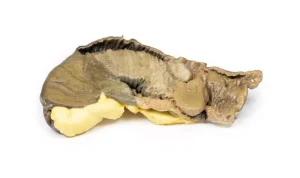Intussusception of small bowel due to metastatic tumour