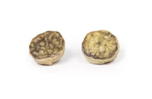 Nodular hyperplasia of the Prostate