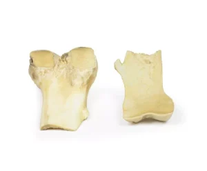 Osteochondroma