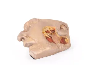 Parotid Gland and Facial Nerve dissection